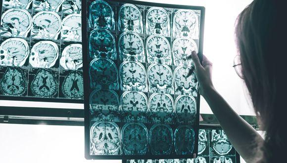 Illustrative: Alzheimer's Disease on MRI
